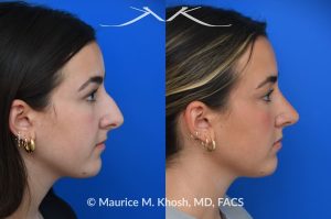 Photo of a patient before and after a procedure. Rhinoplasty to improve breathing, correct nasal deviation, and reduce nasal hump  - before and after photos.