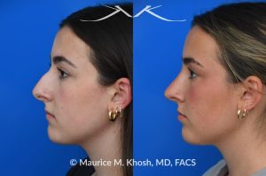 Photo of a patient before and after a procedure. Rhinoplasty to improve breathing, correct nasal deviation, and reduce nasal hump  - before and after photos.