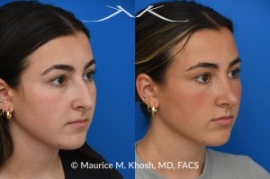 Photo of a patient before and after a procedure. Rhinoplasty to improve breathing, correct nasal deviation, and reduce nasal hump  - before and after photos.