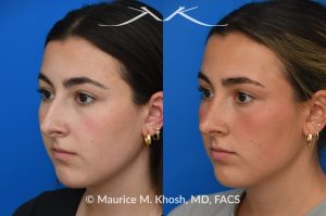 Photo of a patient before and after a procedure. Rhinoplasty to improve breathing, correct nasal deviation, and reduce nasal hump  - before and after photos.