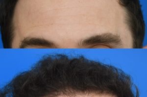 Photo of a patient before and after a procedure. FUE Hair Transplantation to improve frontal and temporal receeding hairline - photo before nad after procedure.