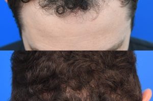Photo of a patient before and after a procedure. FUE Hair Transplantation to improve frontal and temporal receeding hairline - photo before nad after procedure.