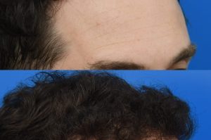 Photo of a patient before and after a procedure. FUE Hair Transplantation to improve frontal and temporal receeding hairline - photo before nad after procedure.