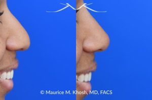Photo of a patient before and after a procedure. Liquid rhinoplasty - photo before and after procedure.