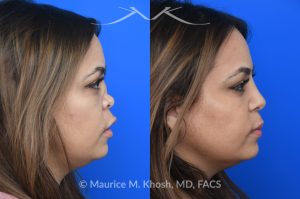 Photo of a patient before and after a procedure. Saddle Nose - This lovely patient had developed saddle collapse of the nose, over-rotation of the nasal tip, and severe nasal obstruction, associated with a septum perforation. In the operating room, a segment of her rib was used to create cartilage grafts to augment the dorsum, and support the nasal tip. A shield graft was fashioned to enhance her nasal tip. Alloderm graft was applied above the dorsal cartilage graft, under the skin. Internal nasal scar tissue was released to further improve breathing. 