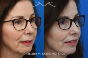 Photo of a patient before and after a procedure. Lip Lift - before and after photos.