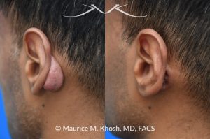 Photo of a patient before and after a procedure. Repair of post-auricular keloid due to prior otoplasty surgery - This procedure involved the repair of a post-auricular keloid that developed after a previous otoplasty surgery. The treatment aimed to reduce the keloid's size and improve the appearance and comfort of the ear area.