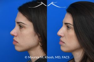 Photo of a patient before and after a procedure. Revision rhinoplasty for nasal dorsum and tip correction - This revision rhinoplasty addressed over-resection of the nasal dorsum and over-rotation of the tip using ear cartilage and Alloderm.