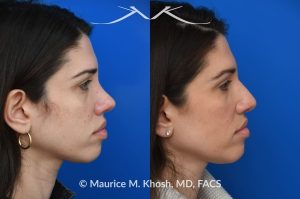 Photo of a patient before and after a procedure. Revision rhinoplasty for nasal dorsum and tip correction - This revision rhinoplasty addressed over-resection of the nasal dorsum and over-rotation of the tip using ear cartilage and Alloderm.