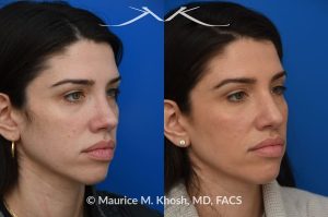 Photo of a patient before and after a procedure. Revision rhinoplasty for nasal dorsum and tip correction - This revision rhinoplasty addressed over-resection of the nasal dorsum and over-rotation of the tip using ear cartilage and Alloderm.
