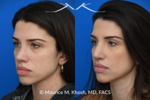 Photo of a patient before and after a procedure. Revision rhinoplasty for nasal dorsum and tip correction - This revision rhinoplasty addressed over-resection of the nasal dorsum and over-rotation of the tip using ear cartilage and Alloderm.