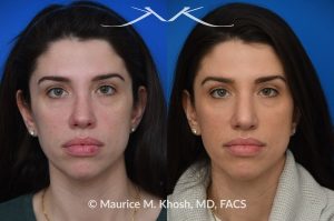 Photo of a patient before and after a procedure. Revision rhinoplasty for nasal dorsum and tip correction - This revision rhinoplasty addressed over-resection of the nasal dorsum and over-rotation of the tip using ear cartilage and Alloderm.