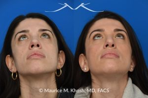 Photo of a patient before and after a procedure. Revision rhinoplasty for nasal dorsum and tip correction - This revision rhinoplasty addressed over-resection of the nasal dorsum and over-rotation of the tip using ear cartilage and Alloderm.