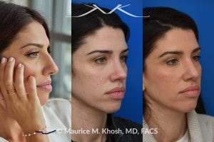 Photo of a patient before and after a procedure. Revision rhinoplasty for nasal dorsum and tip correction - This revision rhinoplasty addressed the over-resection of the nasal dorsum and over-rotation of the nasal tip, using ear cartilage and Alloderm for reconstruction. The left image shows the pre-operative appearance, while the middle image shows the nose before the revision procedure.