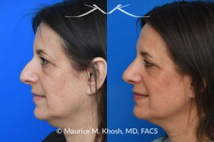 Photo of a patient before and after a procedure. Rhinoplasty for nasal hump and droopy tip - before and after photos.