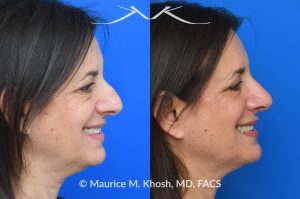 Photo of a patient before and after a procedure. Rhinoplasty for nasal hump and droopy tip - before and after photos.