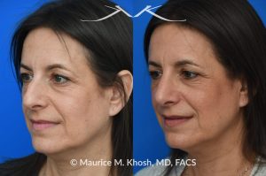 Photo of a patient before and after a procedure. Rhinoplasty for nasal hump and droopy tip - before and after photos.