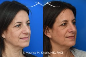 Photo of a patient before and after a procedure. Rhinoplasty for nasal hump and droopy tip - before and after photos.