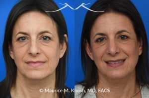 Photo of a patient before and after a procedure. Rhinoplasty for nasal hump and droopy tip - before and after photos.