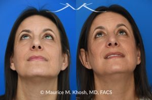 Photo of a patient before and after a procedure. Rhinoplasty for nasal hump and droopy tip - before and after photos.
