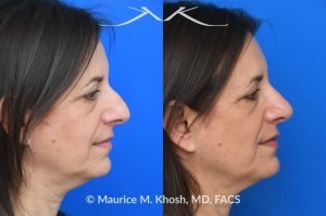 Photo of a patient before and after a procedure. Rhinoplasty for nasal hump and droopy tip - before and after photos.