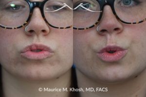 Photo of a patient before and after a procedure. Right Upper Lip Scar Removal - Prior trauma had resulted in a visible mass in the right upper lip. Scar revision of the lip allowed restoration of normal lip contour.