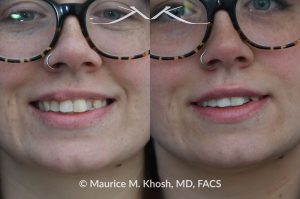 Photo of a patient before and after a procedure. Right Upper Lip Scar Removal - Prior trauma had resulted in a visible mass in the right upper lip. Scar revision of the lip allowed restoration of normal lip contour.