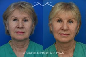 Photo of a patient before and after a procedure. Brow lift - Our delightful patient was interested in overall facial rejuvenation. She underwent lower blepharoplasty with orbital fat repositioning, temporal brow lift, and a deep plane facelift. She is ecstatic with her surgical results.