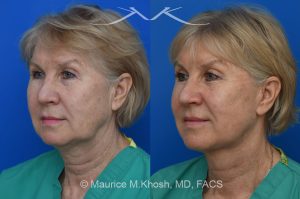 Photo of a patient before and after a procedure. Brow lift - Our delightful patient was interested in overall facial rejuvenation. She underwent lower blepharoplasty with orbital fat repositioning, temporal brow lift, and a deep plane facelift. She is ecstatic with her surgical results.