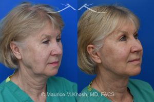 Photo of a patient before and after a procedure. Brow lift - Our delightful patient was interested in overall facial rejuvenation. She underwent lower blepharoplasty with orbital fat repositioning, temporal brow lift, and a deep plane facelift. She is ecstatic with her surgical results.