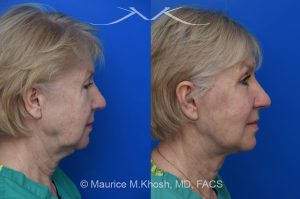 Photo of a patient before and after a procedure. Brow lift - Our delightful patient was interested in overall facial rejuvenation. She underwent lower blepharoplasty with orbital fat repositioning, temporal brow lift, and a deep plane facelift. She is ecstatic with her surgical results.