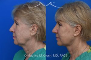 Photo of a patient before and after a procedure. Brow lift - Our delightful patient was interested in overall facial rejuvenation. She underwent lower blepharoplasty with orbital fat repositioning, temporal brow lift, and a deep plane facelift. She is ecstatic with her surgical results.