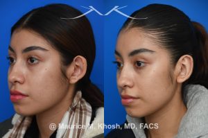 Photo of a patient before and after a procedure. Otoplasty - This young patient had a left ear deformity with over-projection of the upper aspect of the ear due to poor formation of the helical fold of the ear. Unilateral otoplasty was performed in the office under local anesthesia. Mustarde suture technique was used to create a properly contoured helical fold. 