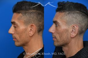 Photo of a patient before and after a procedure. Ear Pinning with Mustarde Sutures - This pleasant patient presented with interest in otoplasty in Manhattan to address prominent ears and reduce auricular projection. The procedure for ear pinning involved conchal setback and Mustarde sutures.