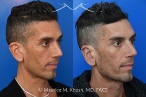 Photo of a patient before and after a procedure. Ear Pinning with Mustarde Sutures - This pleasant patient presented with interest in otoplasty in Manhattan to address prominent ears and reduce auricular projection. The procedure for ear pinning involved conchal setback and Mustarde sutures.