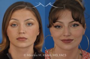 Photo of a patient before and after a procedure. Rhinoplasty to Correct Saddle Nose Deformity Caused by Autoimmune Condition - 27 year old with saddle nose collapse due to an autoimmune condition. She was bothered by the unnatural sag of the bridge of the nose, loss of nasal tip definition, and nasal obstruction. Her own rib cartilage was used during saddle nose rhinoplasty, to reconstruct the nose and restore breathing. The last two images show the computer simulation of surgical outcome (middle picture), as well as the final outcome (the picture on the right side). Patient is delighted with her results. 