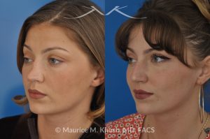 Photo of a patient before and after a procedure. Rhinoplasty to Correct Saddle Nose Deformity Caused by Autoimmune Condition - 27 year old with saddle nose collapse due to an autoimmune condition. She was bothered by the unnatural sag of the bridge of the nose, loss of nasal tip definition, and nasal obstruction. Her own rib cartilage was used during saddle nose rhinoplasty, to reconstruct the nose and restore breathing. The last two images show the computer simulation of surgical outcome (middle picture), as well as the final outcome (the picture on the right side). Patient is delighted with her results. 
