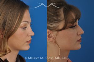 Photo of a patient before and after a procedure. Rhinoplasty to Correct Saddle Nose Deformity Caused by Autoimmune Condition - 27 year old with saddle nose collapse due to an autoimmune condition. She was bothered by the unnatural sag of the bridge of the nose, loss of nasal tip definition, and nasal obstruction. Her own rib cartilage was used during saddle nose rhinoplasty, to reconstruct the nose and restore breathing. The last two images show the computer simulation of surgical outcome (middle picture), as well as the final outcome (the picture on the right side). Patient is delighted with her results. 