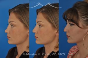 Photo of a patient before and after a procedure. Rhinoplasty to Correct Saddle Nose Deformity Caused by Autoimmune Condition - 27 year old with saddle nose collapse due to an autoimmune condition. She was bothered by the unnatural sag of the bridge of the nose, loss of nasal tip definition, and nasal obstruction. Her own rib cartilage was used during saddle nose rhinoplasty, to reconstruct the nose and restore breathing. The last two images show the computer simulation of surgical outcome (middle picture), as well as the final outcome (the picture on the right side). Patient is delighted with her results. 