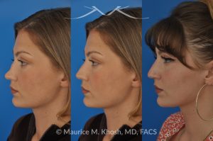 Photo of a patient before and after a procedure. Rhinoplasty to Correct Saddle Nose Deformity Caused by Autoimmune Condition - 27 year old with saddle nose collapse due to an autoimmune condition. She was bothered by the unnatural sag of the bridge of the nose, loss of nasal tip definition, and nasal obstruction. Her own rib cartilage was used during saddle nose rhinoplasty, to reconstruct the nose and restore breathing. The last two images show the computer simulation of surgical outcome (middle picture), as well as the final outcome (the picture on the right side). Patient is delighted with her results. 