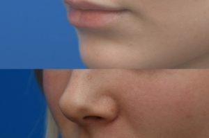 Photo of a patient before and after a procedure. Lip Augmentation with HA Filler - Before and after photo showing improved fullness and symmetry of the lips.