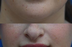Photo of a patient before and after a procedure. Lip Augmentation with HA Filler - Before and after photo showing improved fullness and symmetry of the lips.