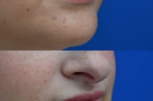 Photo of a patient before and after a procedure. Lip Augmentation with HA Filler - Before and after photo showing improved fullness and symmetry of the lips.
