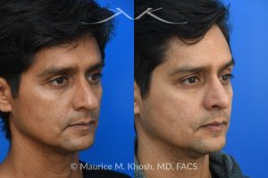Photo of a patient before and after a procedure. Rhinoplasty for Hump Reduction, Tip Elevation, and Nasal Refinement - Rhinoplasty was performed through the open approach to reduce the nasal hump (radix graft as well as dorsal shave), elevate the tip (septo-columellar sutures), and refine the lower nose (alar strut grafts and cephalic trimming). The patient is ecstatic about the final outcome which is completely natural and perfectly complementary to his face. 
