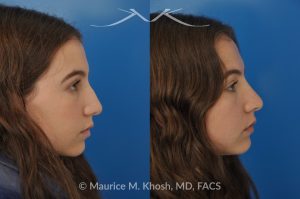Photo of a patient before and after a procedure. Natural Rhinoplasty: Smoothing the Hump & Refining the Tip - before-and-after composite photo.