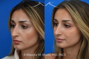 Photo of a patient before and after a procedure. Saddle Nose Rhinoplasty with Rib Cartilage Reconstruction - This young patient was interested in eliminating her nasal hump and improving her droopy appearing nasal tip. She was also interested in addressing her nasal breathing obstruction. An open approach rhinoplasty was used to achieve a smooth dorsal profile, and elevate and refine her nasal tip. Her deviated septum was also corrected during the surgery. 
