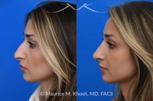 Photo of a patient before and after a procedure. Saddle Nose Rhinoplasty with Rib Cartilage Reconstruction - This young patient was interested in eliminating her nasal hump and improving her droopy appearing nasal tip. She was also interested in addressing her nasal breathing obstruction. An open approach rhinoplasty was used to achieve a smooth dorsal profile, and elevate and refine her nasal tip. Her deviated septum was also corrected during the surgery. 
