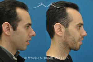 Photo of a patient before and after a procedure. Rhinoplasty for Hump Reduction, Tip Refinement and Nostril Narrowing - This gentleman was interested in rhinoplasty to address a large hump, wide tip, excess nostril show, and wide nostrils. Surgery was performed via the open rhinoplasty approach.
