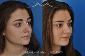 Photo of a patient before and after a procedure. Rhinoplasty to Straighten a Crooked Nose and Refine the Nasal Profile - before-and-after composite photo.