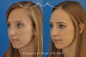 Photo of a patient before and after a procedure. Rhinoplasty to Reduce a Nose Hump, Elevate the Nose Tip, and Refine the Nose Tip - before-and-after composite photo.